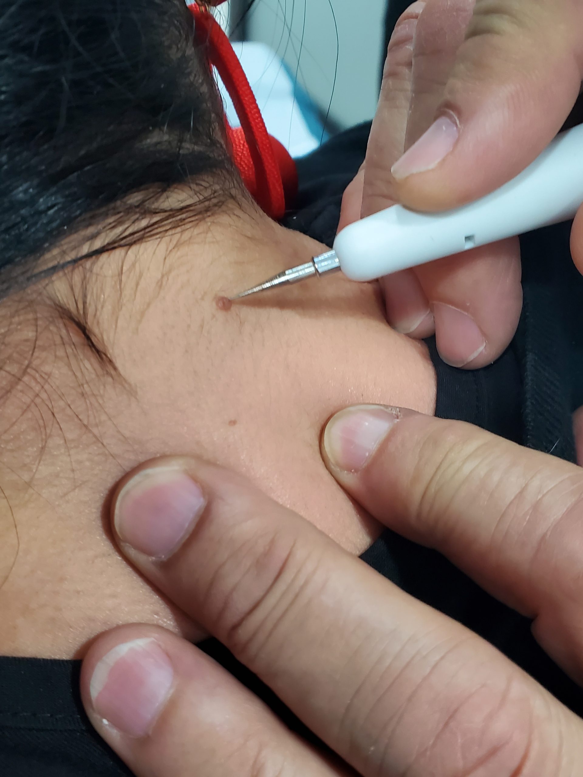 pictures of skin tags on forehead